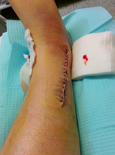 The outside of the foot, 15 stitches total.  That's where the docs put a plate in.